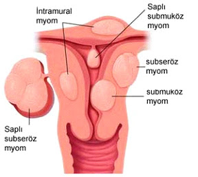 myom.jpg